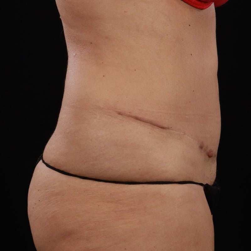Abdominoplasty (Tummy Tuck) Before & After Gallery - Patient 350514 - Image 5