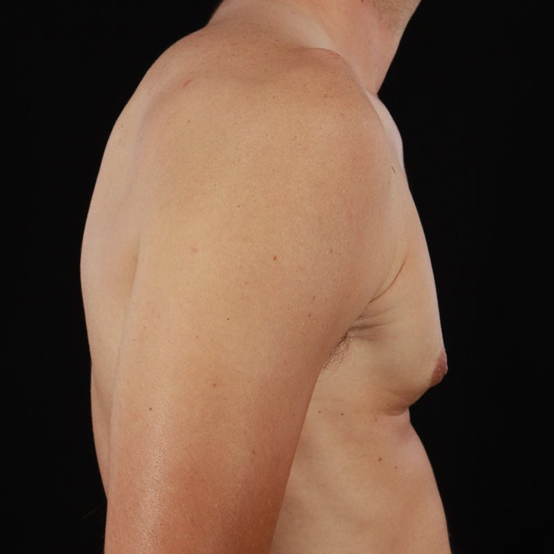 Gynecomastia Before & After Gallery - Patient 182904 - Image 6