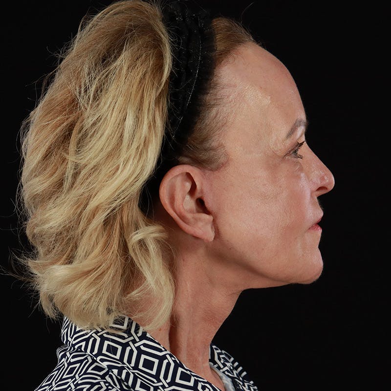 Facelift Before & After Gallery - Patient 146873 - Image 6