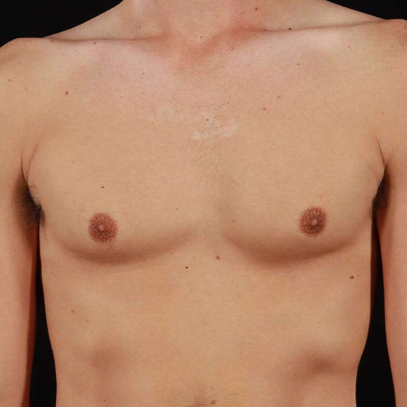 Gynecomastia Before & After Gallery - Patient 182904 - Image 1