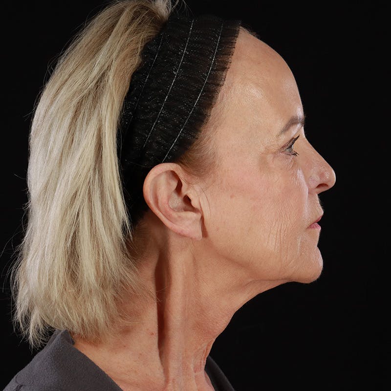Facelift Before & After Gallery - Patient 146873 - Image 5