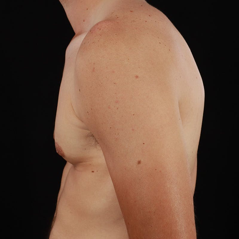 Gynecomastia Before & After Gallery - Patient 182904 - Image 10