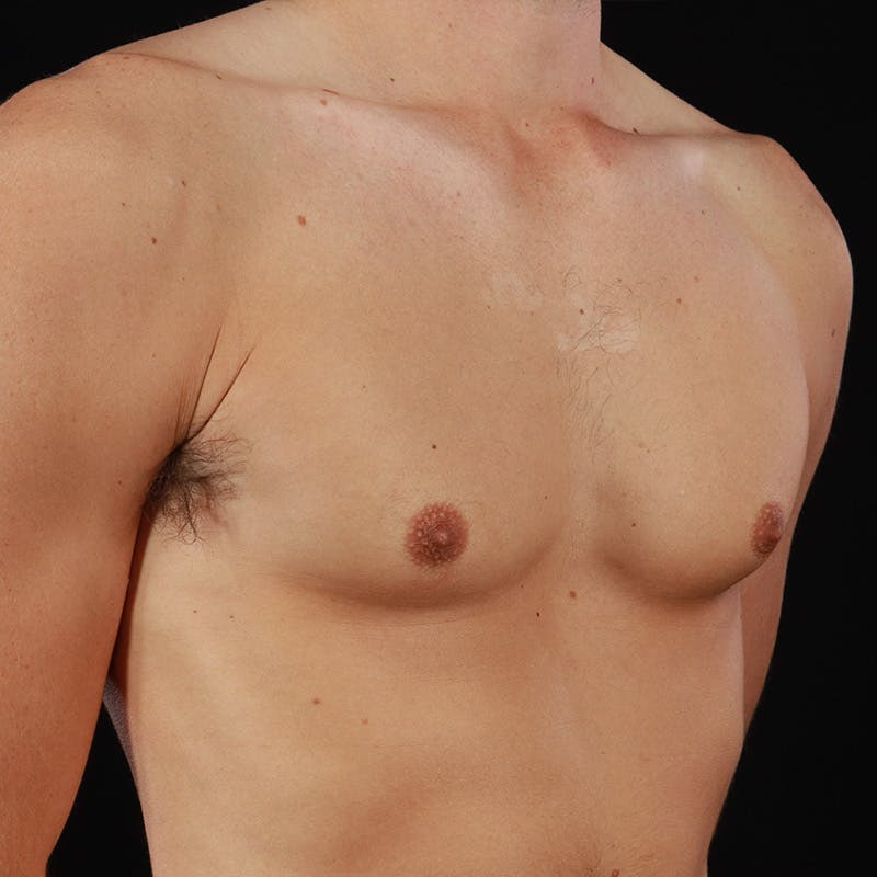 Gynecomastia Before & After Gallery - Patient 182904 - Image 3
