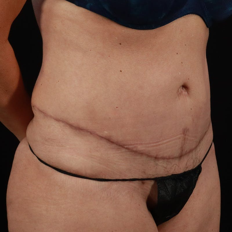 Abdominoplasty (Tummy Tuck) Before & After Gallery - Patient 350514 - Image 4