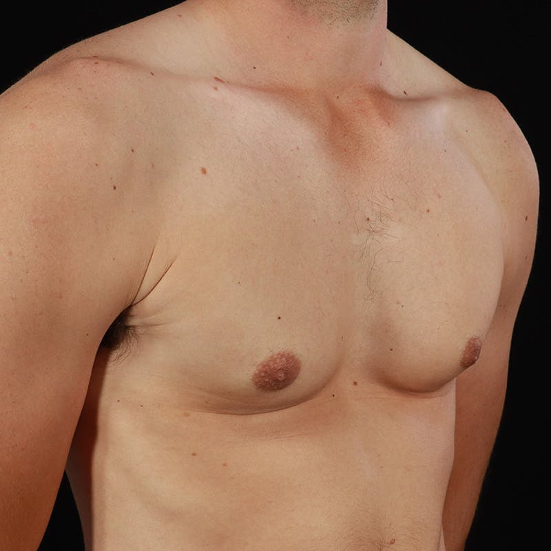 Gynecomastia Before & After Gallery - Patient 182904 - Image 4