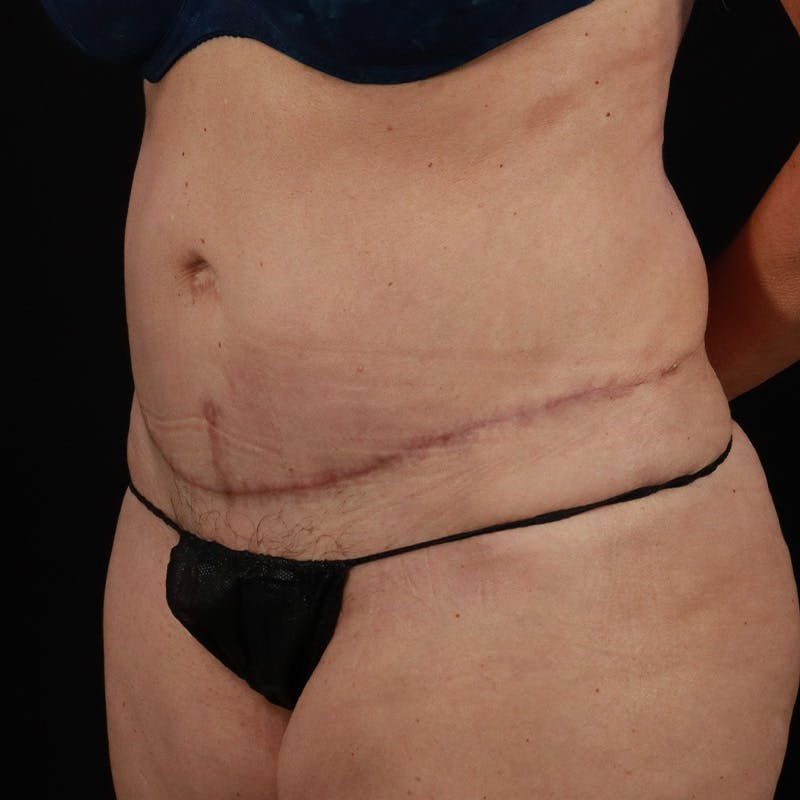 Abdominoplasty (Tummy Tuck) Before & After Gallery - Patient 350514 - Image 8