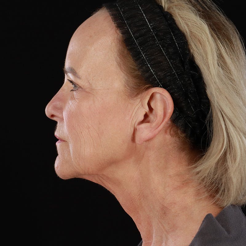 Facelift Before & After Gallery - Patient 146873 - Image 9