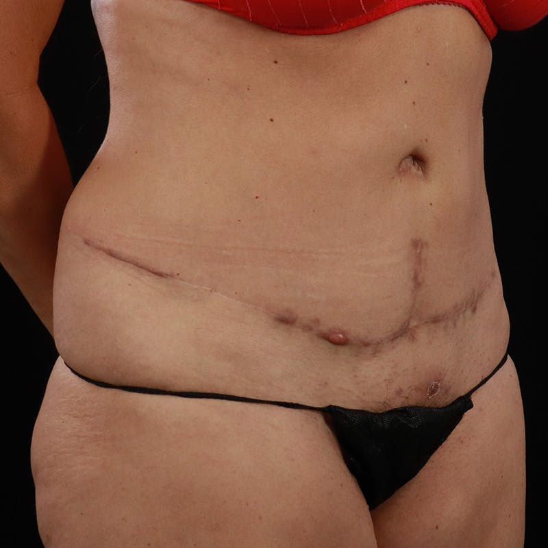 Abdominoplasty (Tummy Tuck) Before & After Gallery - Patient 350514 - Image 3
