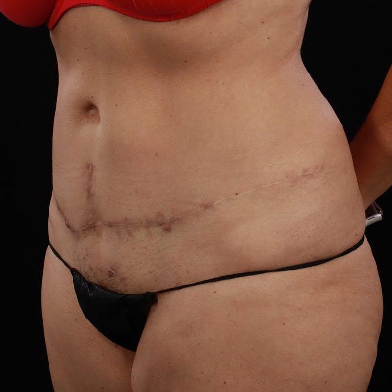 Abdominoplasty (Tummy Tuck) Before & After Gallery - Patient 350514 - Image 7