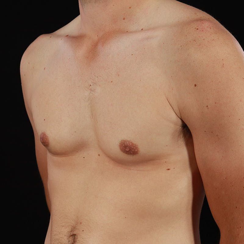 Gynecomastia Before & After Gallery - Patient 182904 - Image 8