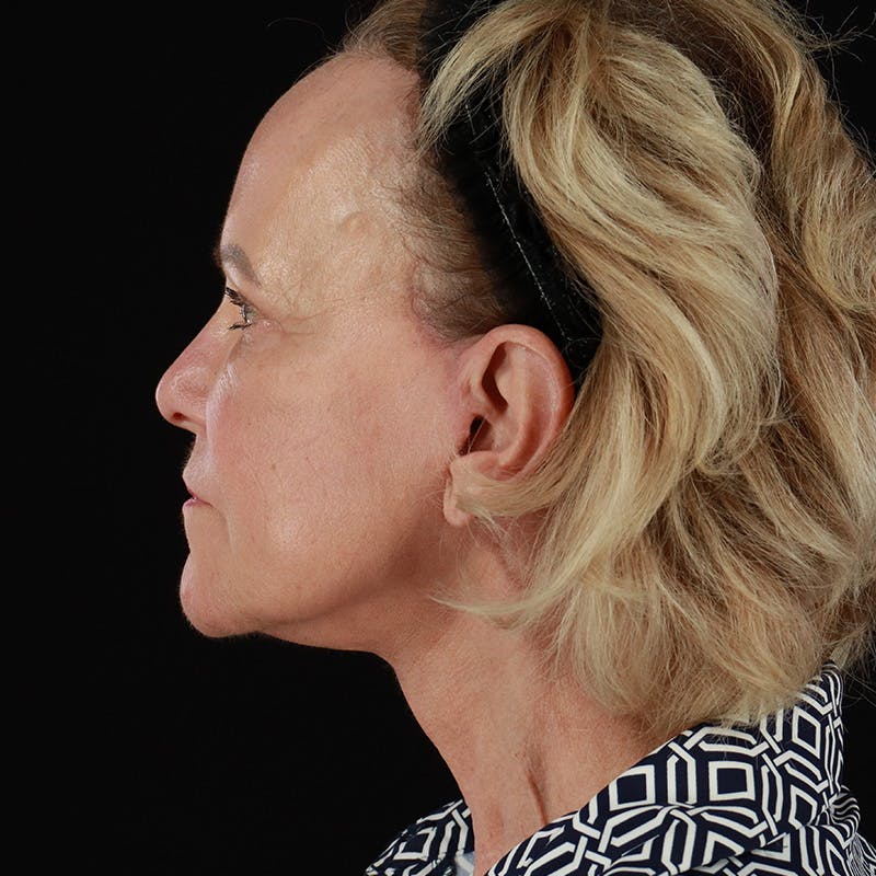 Facelift Before & After Gallery - Patient 146873 - Image 10