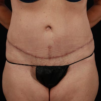 Abdominoplasty (Tummy Tuck) Before & After Gallery - Patient 350514 - Image 2