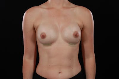 Motiva Preserve Breast Augmentation Before & After Gallery - Patient 250818 - Image 2