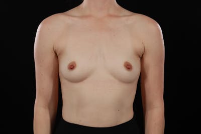 Motiva Preserve Breast Augmentation Before & After Gallery - Patient 250818 - Image 1
