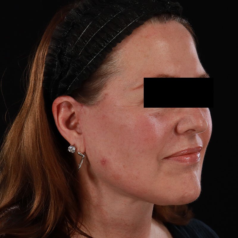 Facelift Before & After Gallery - Patient 620977 - Image 4