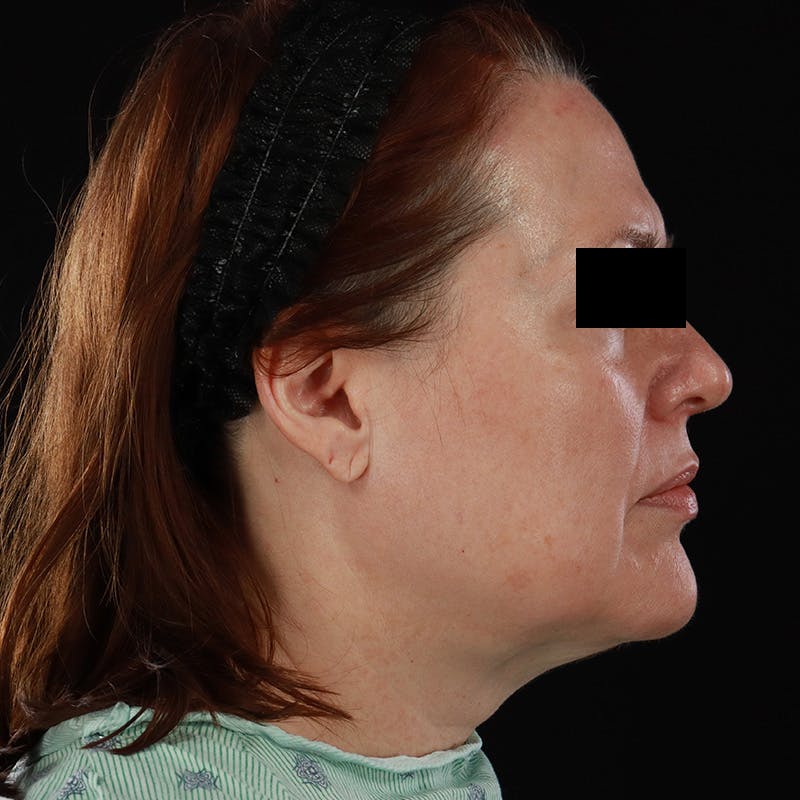 Facelift Before & After Gallery - Patient 620977 - Image 5