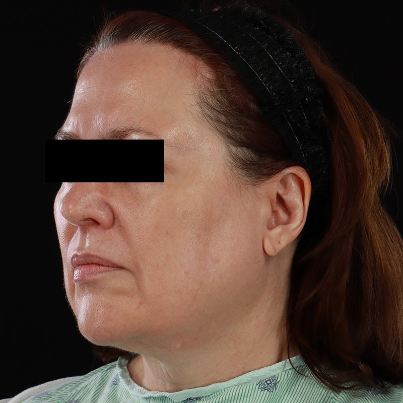 Facelift Before & After Gallery - Patient 620977 - Image 7