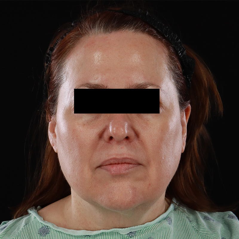 Facelift Before & After Gallery - Patient 620977 - Image 1