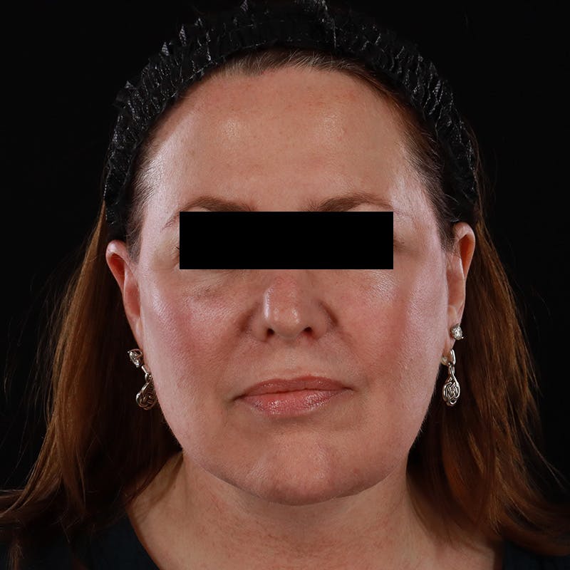 Facelift Before & After Gallery - Patient 620977 - Image 2