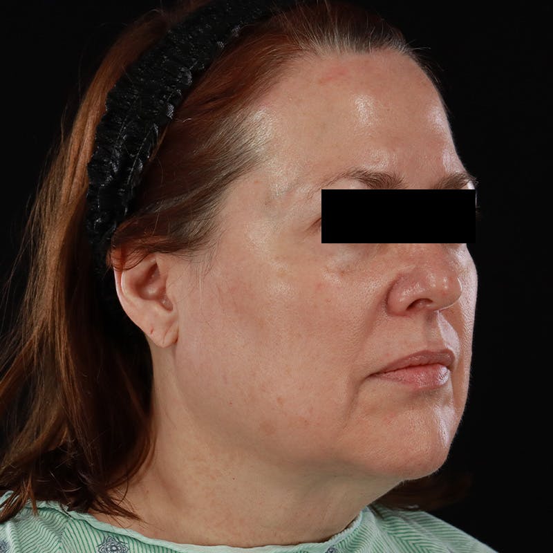 Facelift Before & After Gallery - Patient 620977 - Image 3