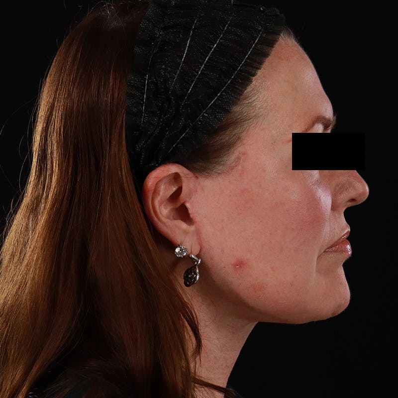 Facelift Before & After Gallery - Patient 620977 - Image 6