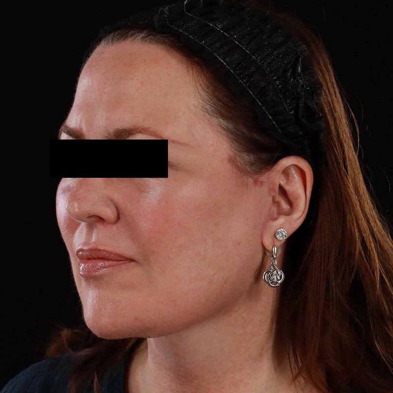 Facelift Before & After Gallery - Patient 620977 - Image 8