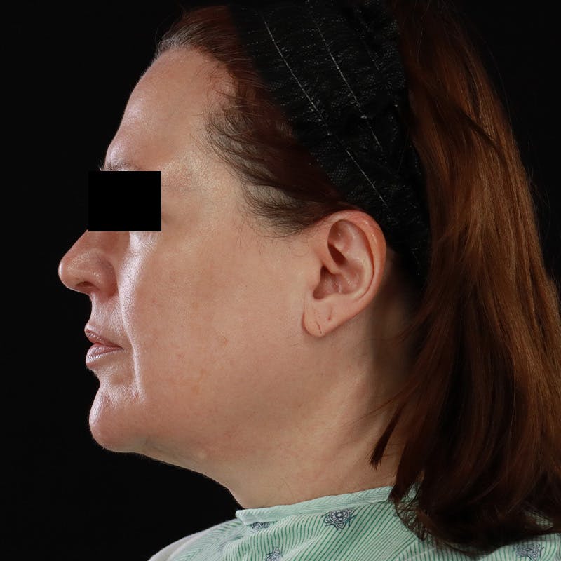 Facelift Before & After Gallery - Patient 620977 - Image 9