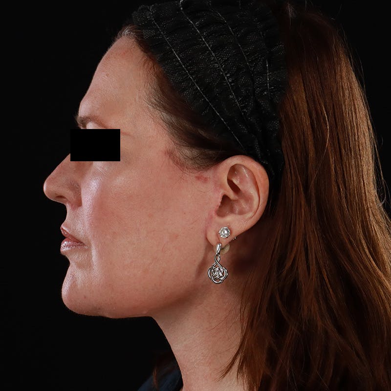 Facelift Before & After Gallery - Patient 620977 - Image 10