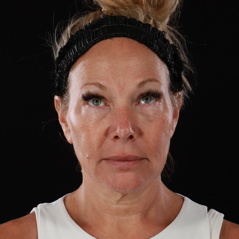 Facelift Before & After Gallery - Patient 353614 - Image 3