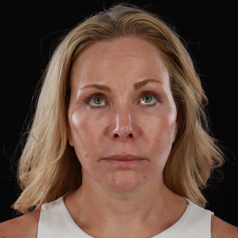 Facelift Before & After Gallery - Patient 353614 - Image 4