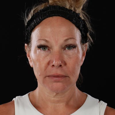 Contour Total Resurfacing Laser Before & After Gallery - Patient 407326 - Image 1