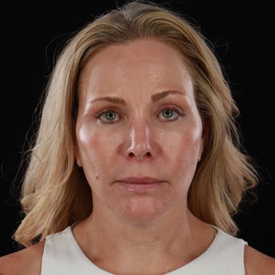 Contour Total Resurfacing Laser Before & After Gallery - Patient 407326 - Image 2