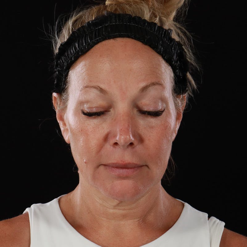 Facelift Before & After Gallery - Patient 353614 - Image 5