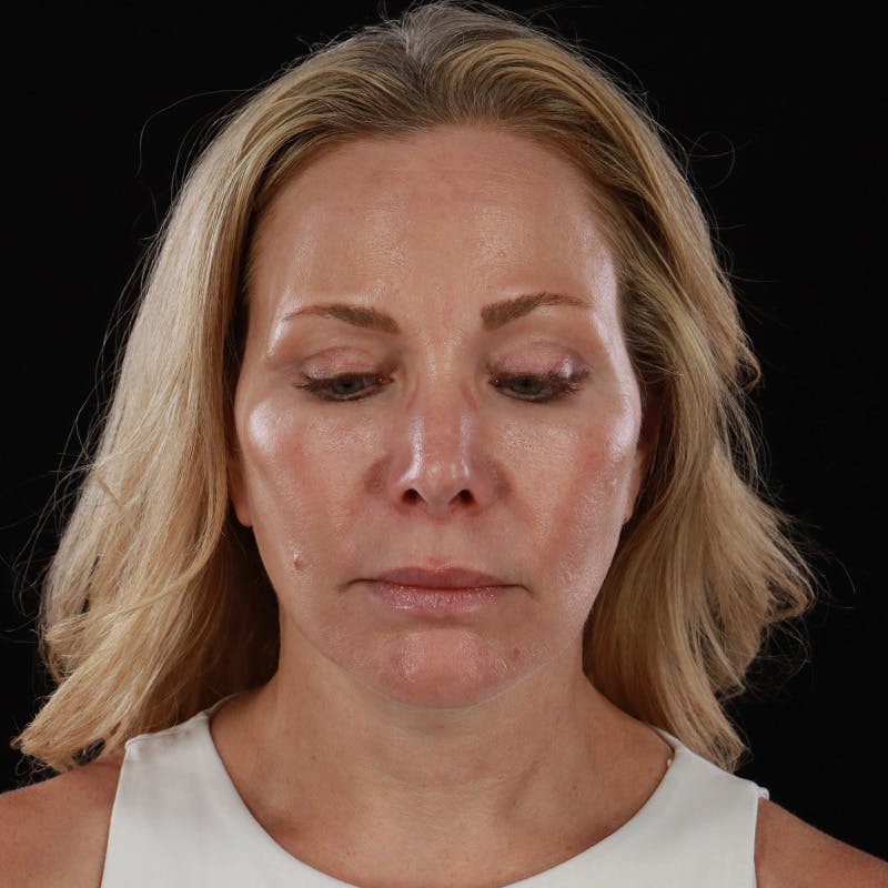 Facelift Before & After Gallery - Patient 353614 - Image 6