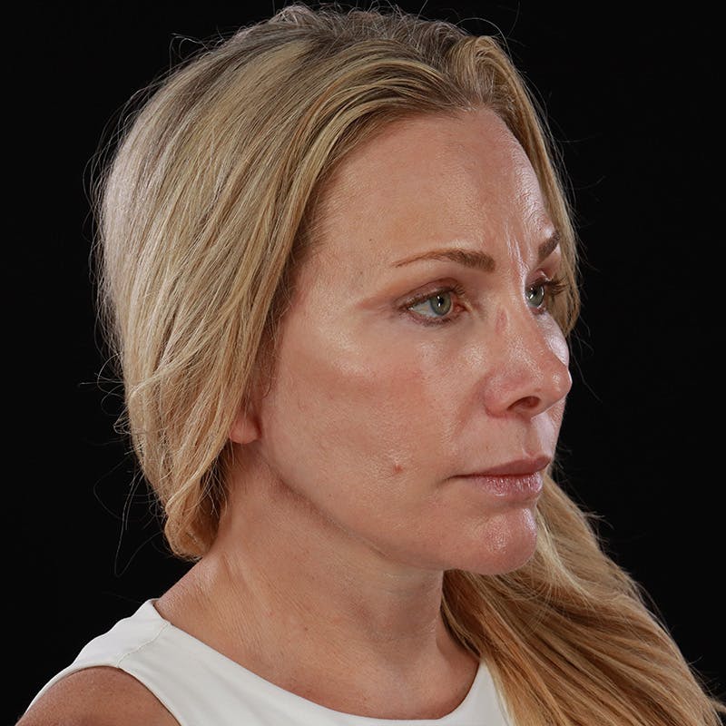 Facelift Before & After Gallery - Patient 353614 - Image 8