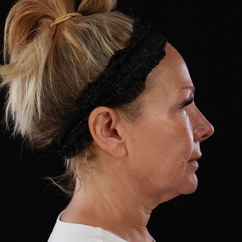 Facelift Before & After Gallery - Patient 353614 - Image 9