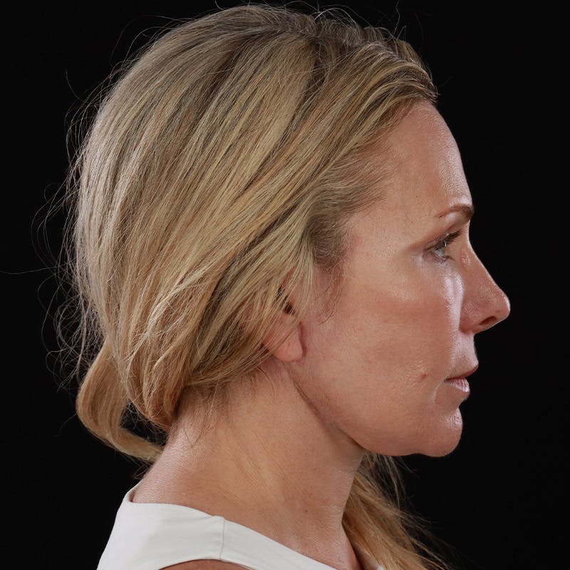 Facelift Before & After Gallery - Patient 353614 - Image 10