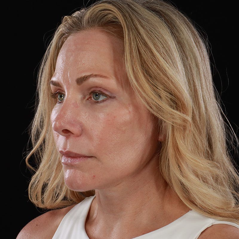 Facelift Before & After Gallery - Patient 353614 - Image 12