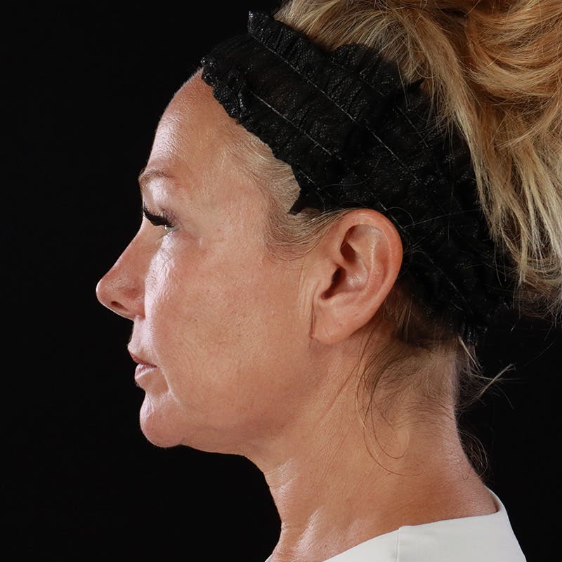 Facelift Before & After Gallery - Patient 353614 - Image 13