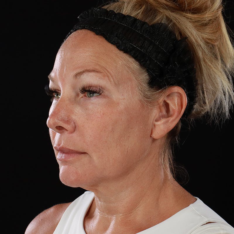 Facelift Before & After Gallery - Patient 353614 - Image 11