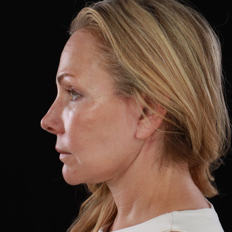 Facelift Before & After Gallery - Patient 353614 - Image 14
