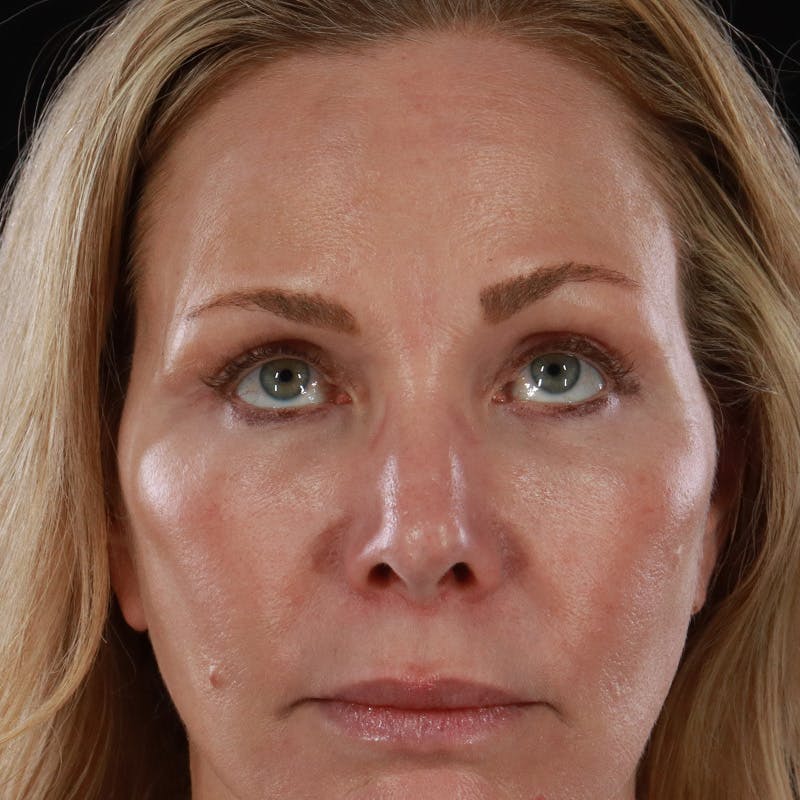 Lower Eyelid Surgery Before & After Gallery - Patient 309752 - Image 4