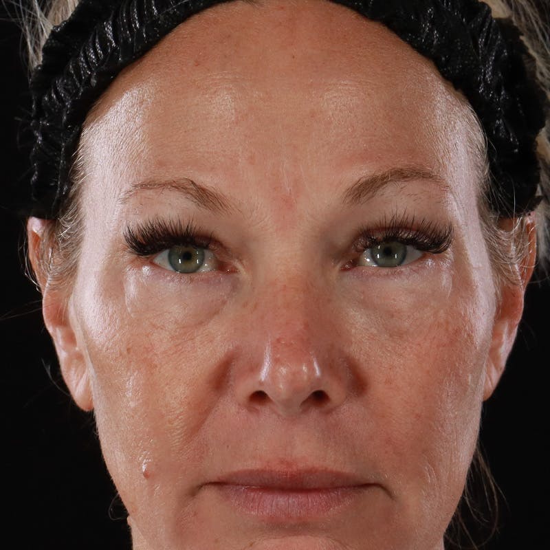 Lower Eyelid Surgery Before & After Gallery - Patient 309752 - Image 1