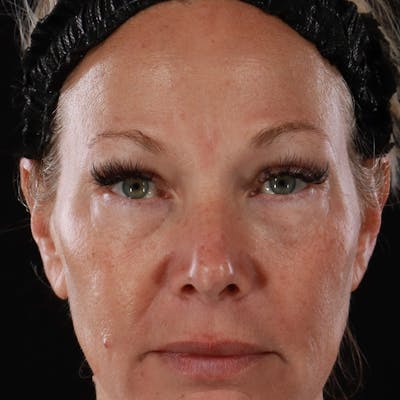 Lower Eyelid Surgery Before & After Gallery - Patient 309752 - Image 1