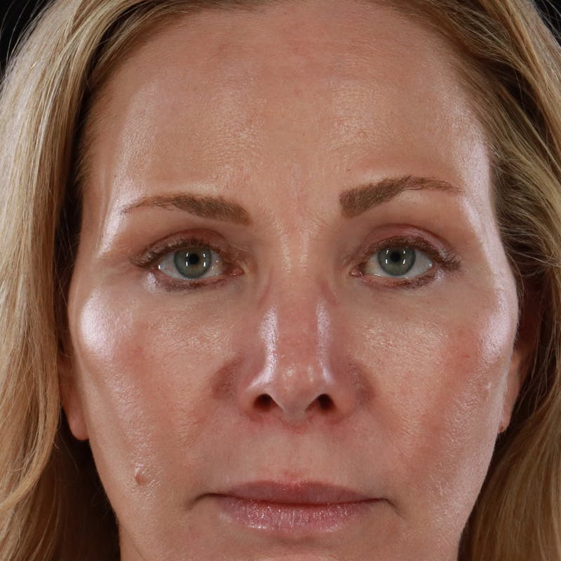 Lower Eyelid Surgery Before & After Gallery - Patient 309752 - Image 2