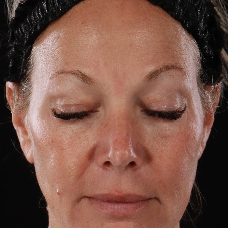 Lower Eyelid Surgery Before & After Gallery - Patient 309752 - Image 5