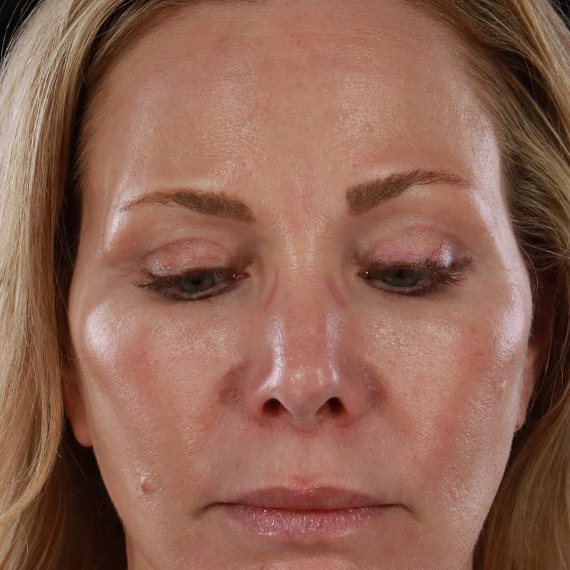 Lower Eyelid Surgery Before & After Gallery - Patient 309752 - Image 6