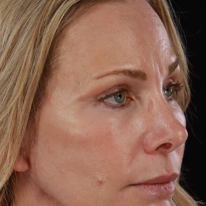 Lower Eyelid Surgery Before & After Gallery - Patient 309752 - Image 8