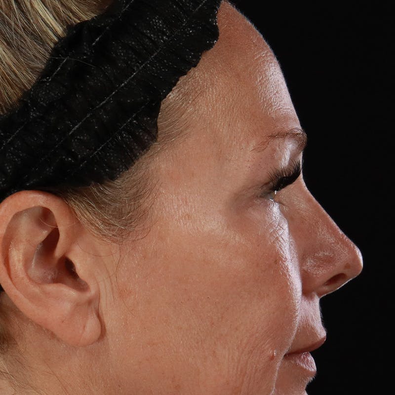 Lower Eyelid Surgery Before & After Gallery - Patient 309752 - Image 9