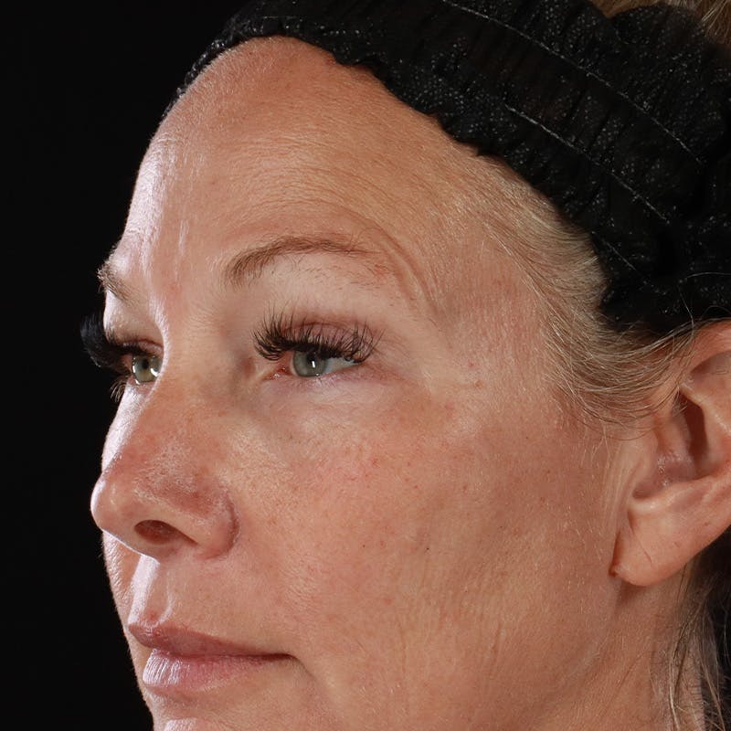 Lower Eyelid Surgery Before & After Gallery - Patient 309752 - Image 11